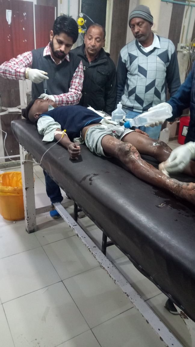 आसरा  ने  आग  से झुलसे  बच्चे  को पहुंचाया  अस्पताल