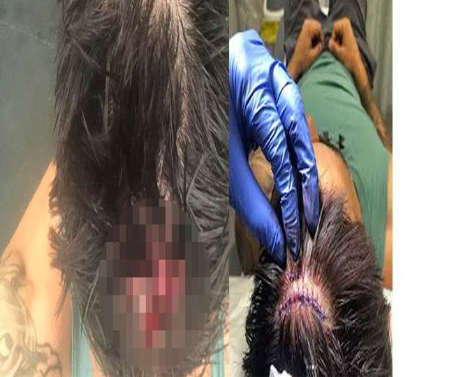 ऑस्ट्रेलिया के पूर्व तेज गेंदबाज मिचेल जॉनसन बुरी तरह से चोटिल