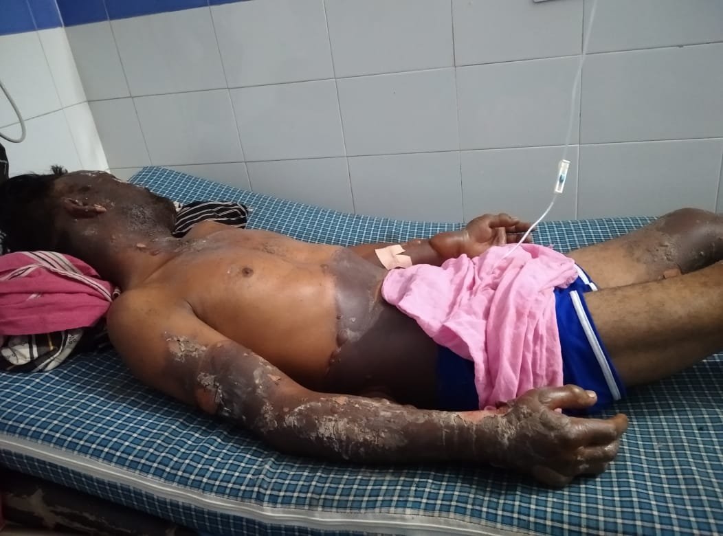 ਪਿੰਡ ਛਾਹੜ ਵਿਖੇ ਇੱਕ ਗ਼ਰੀਬ ਦੇ ਘਰ ਗੈਸ ਸਿਲੰਡਰ ਲੀਕ ਹੋਣ ਕਾਰਨ ਲੱਗੀ ਅੱਗ,ਨੌਜ਼ਵਾਨ ਬੁਰੀ ਤਰ੍ਹਾ ਝੁੱਲਸਿਆ ਗਿਆ,ਹਾਲਤ ਨਾਜ਼ੁਕ, PGI ‘ਚ’ ਜ਼ੇਰੇ ਇਲਾਜ਼।